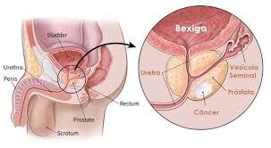 cancer de prostata urologia)